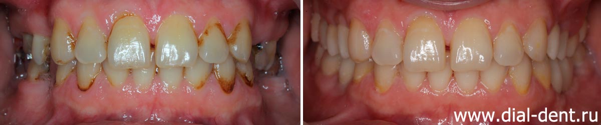 вид зубов до и после комплексного лечения в Диал-Дент