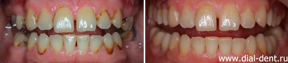 вид зубов до и после комплексного лечения в Диал-Дент
