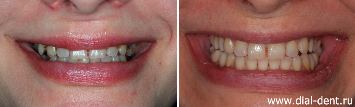 улыбка до и после комплексного лечения в Диал-Дент