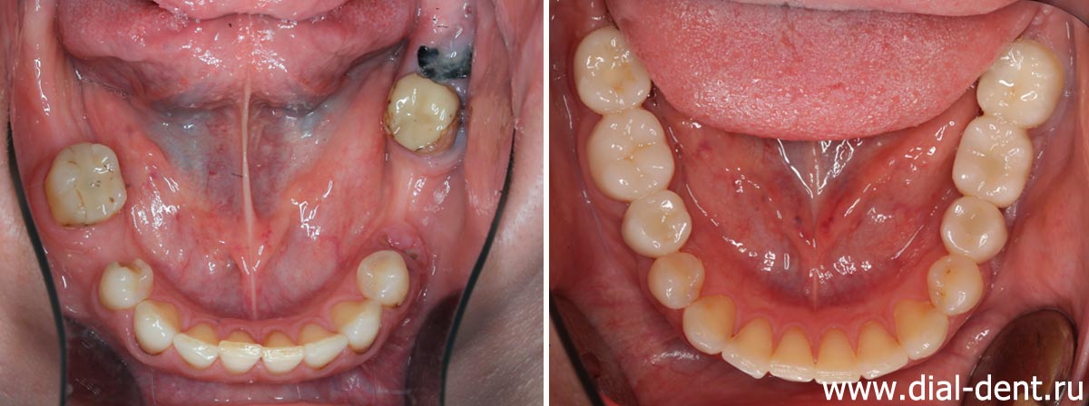 нижние зубы до и после комплексного лечения