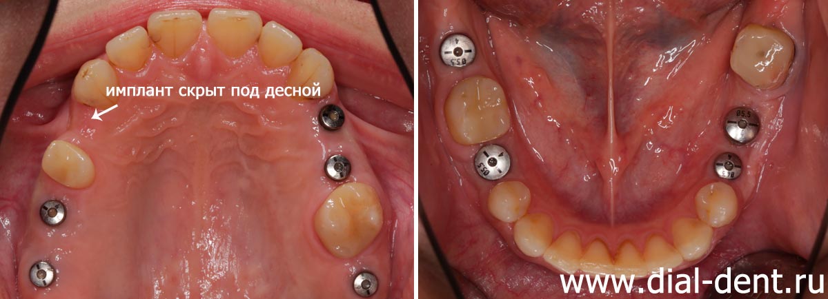 установлено 10 зубных имплантов Astra Tech