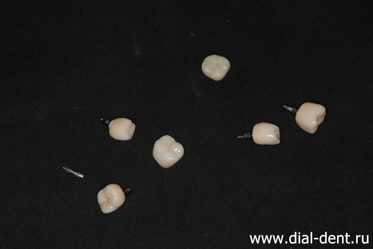 изготовление зубных коронок в лаборатории Диал-Дент, керамика E.max