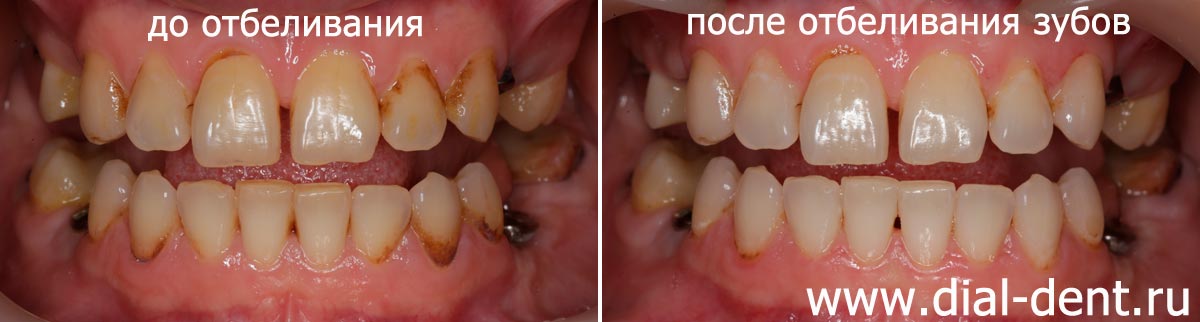 исходный цвет зубов и цвет после отбеливания ZOOM 4