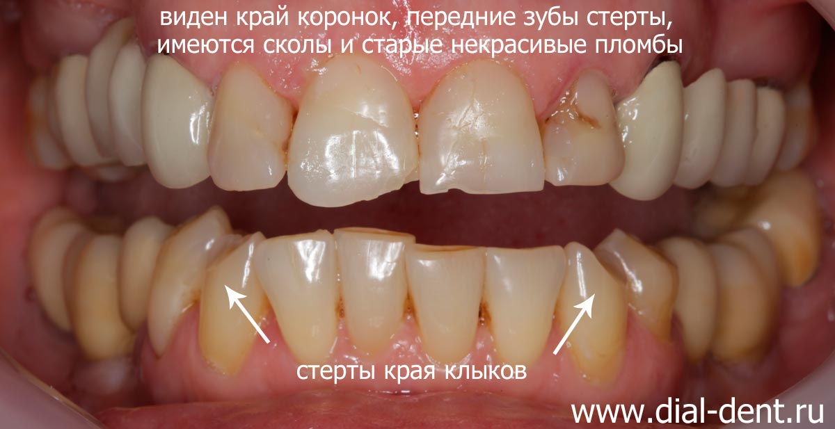 до протезирования верхних зубов
