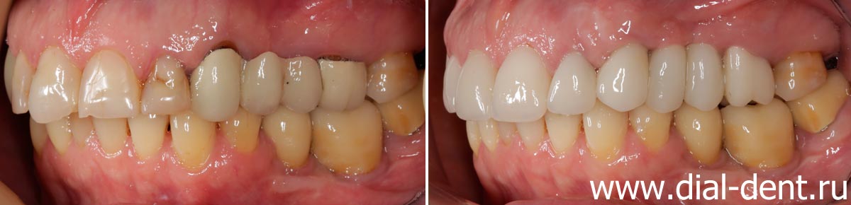 вид зубов слева до и после протезирования