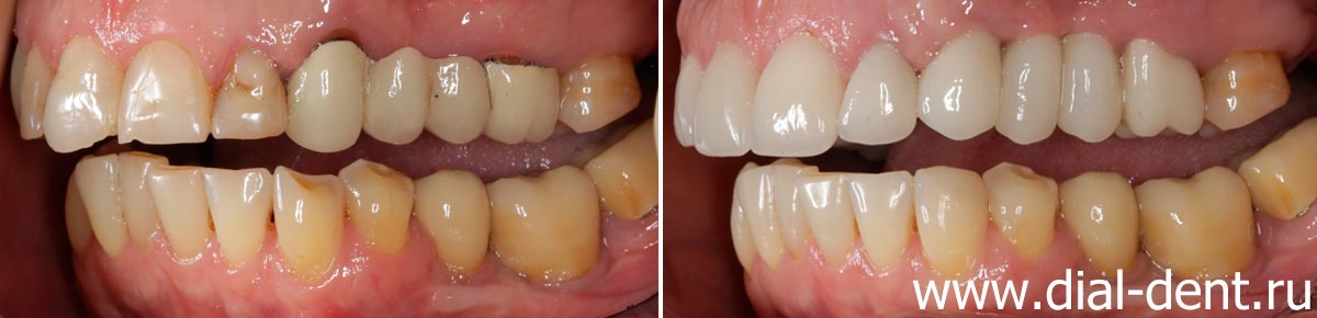 вид зубов слева до и после протезирования