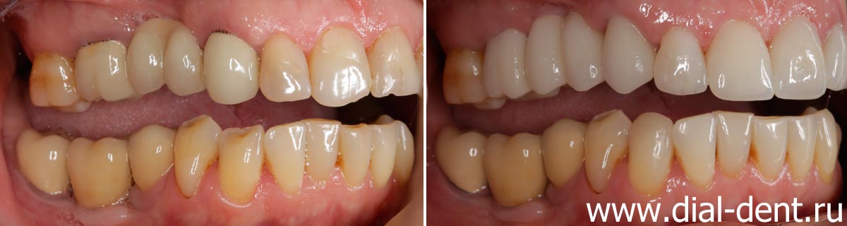 вид зубов справа до и после протезирования
