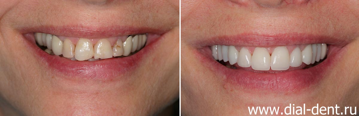 улыбка до и после протезирования верхних зубов