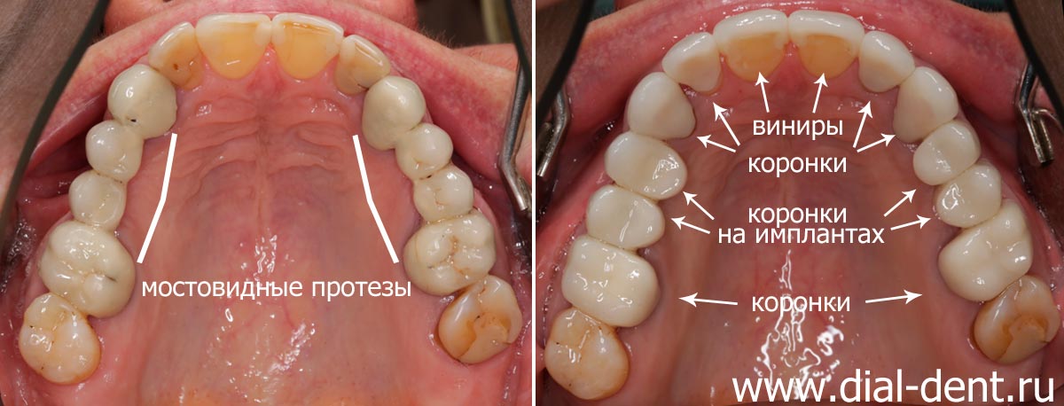 фото до и после протезирования верхних зубов