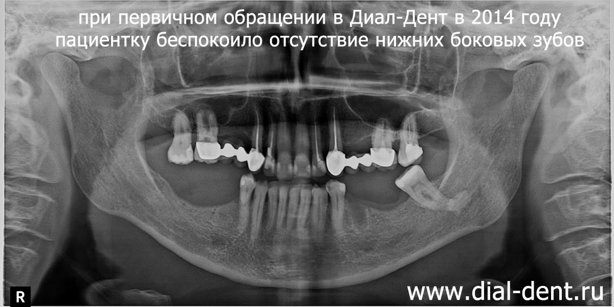 панорамный снимок зубов от 2014 года, нет нижних зубов