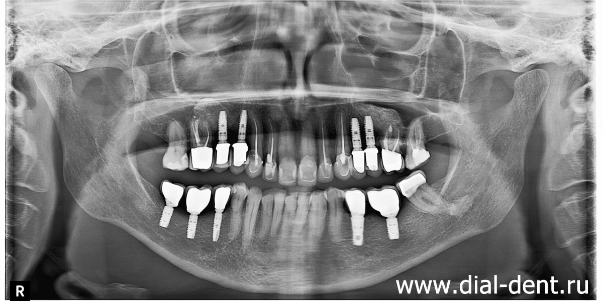 панорамный снимок зубов после протезирования