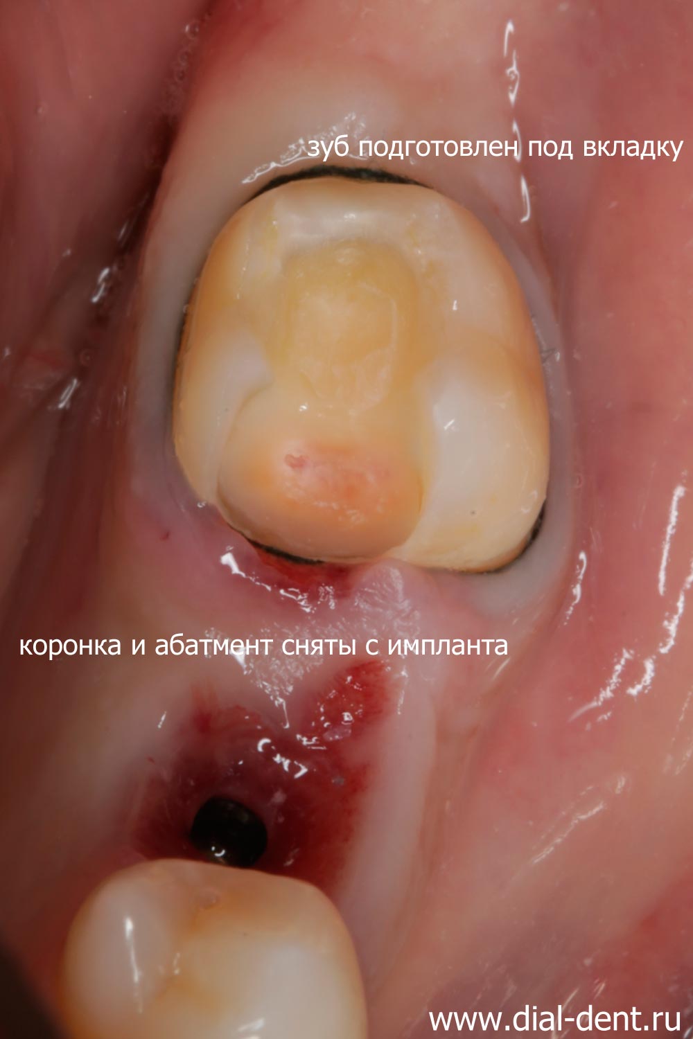 зуб подготовлен под вкладку, коронка с импланта отправлена на коррекцию