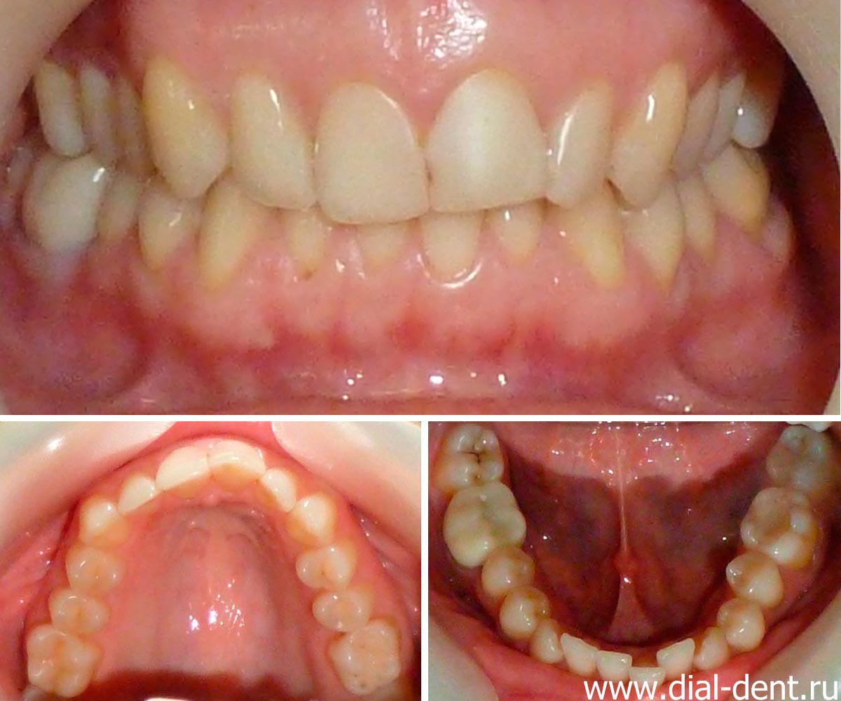 фото зубов до лечения