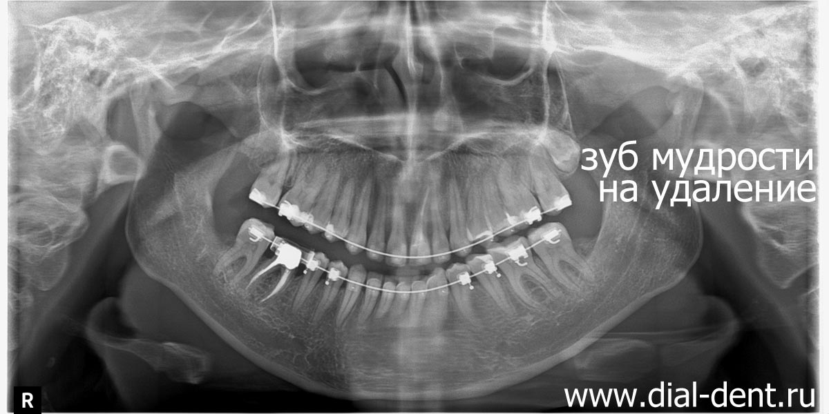 панорамный снимок зубов в процессе лечения