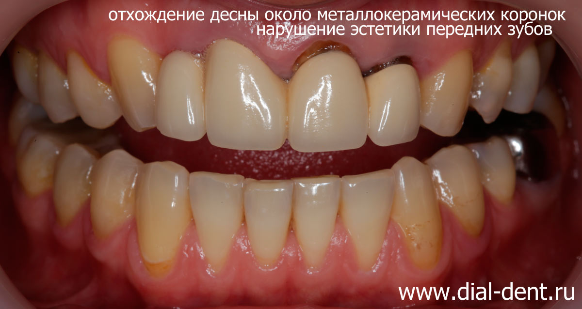вид зубов до лечения