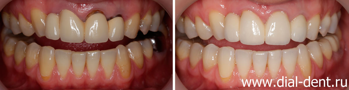 вид зубов до и после протезирования керамикой