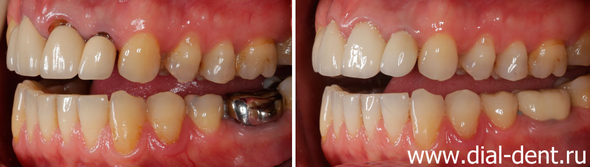 вид слева до и после протезирования зубов керамикой