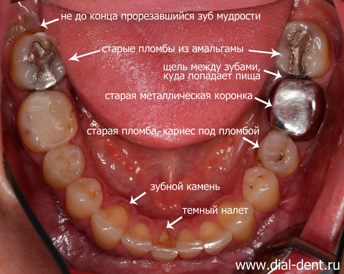 нижние зубы до лечения - металлическая коронка, старые пломбы, кариес