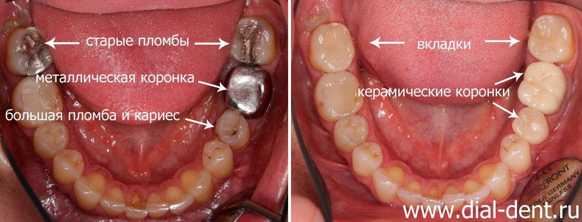нижние зубы до и после замены пломб и коронки