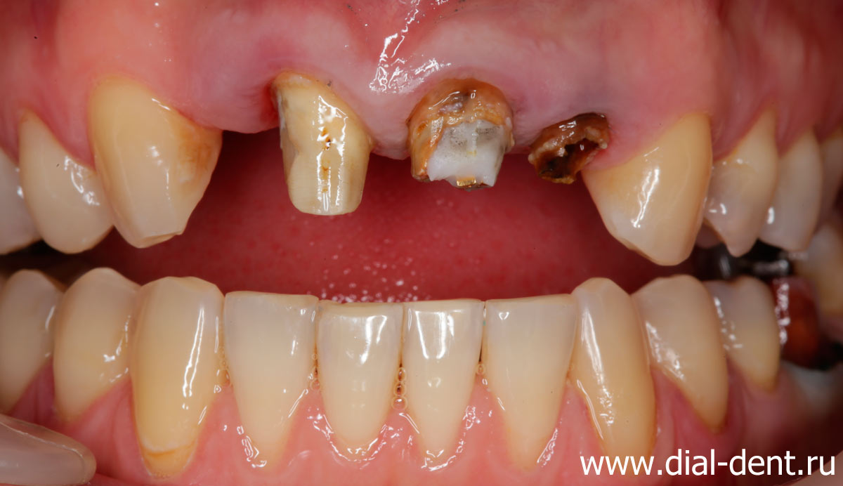 передние зубы после снятия мостовидного протеза