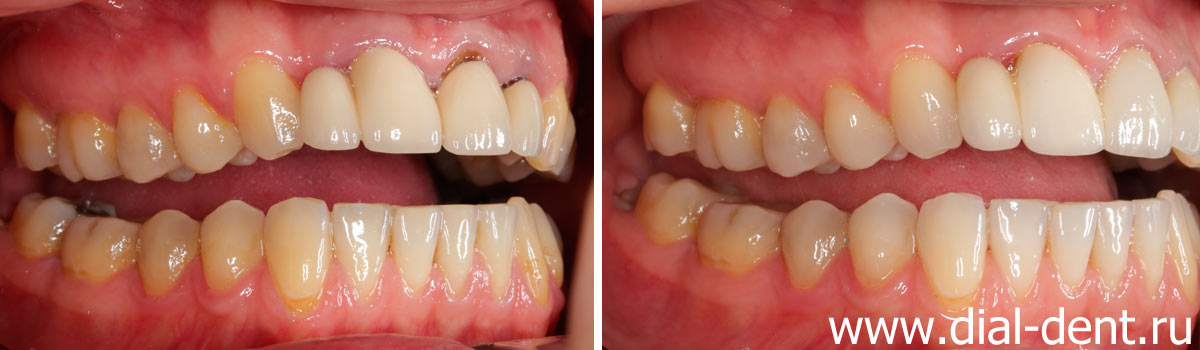 вид справа до и после протезирования зубов керамикой