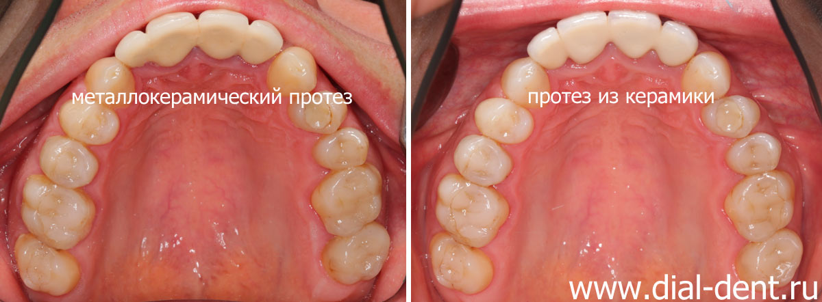 верхние зубы до и после протезирования передних зубов керамикой
