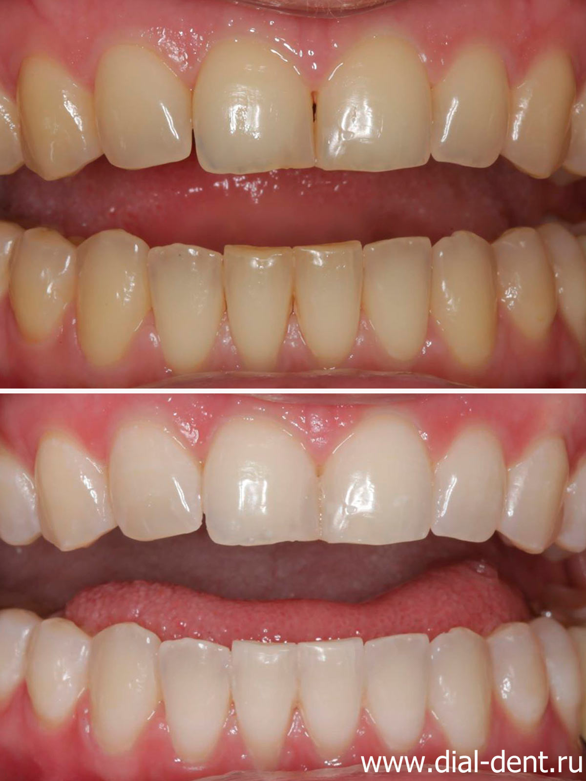 отбеливание зубов ZOOM 4 - исходный цвет и результат отбеливания