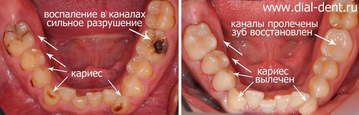 до и после лечения кариеса зубов нижней челюсти