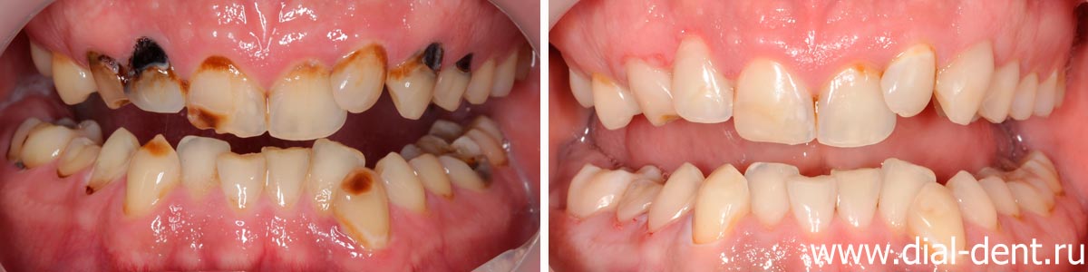 до и после лечения кариеса зубов