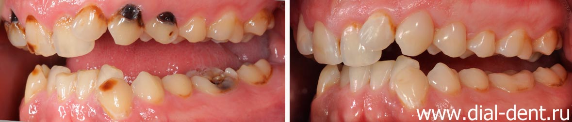 до и после лечения кариеса зубов вид слева
