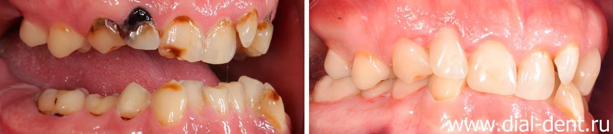 до и после лечения кариеса зубов вид справа