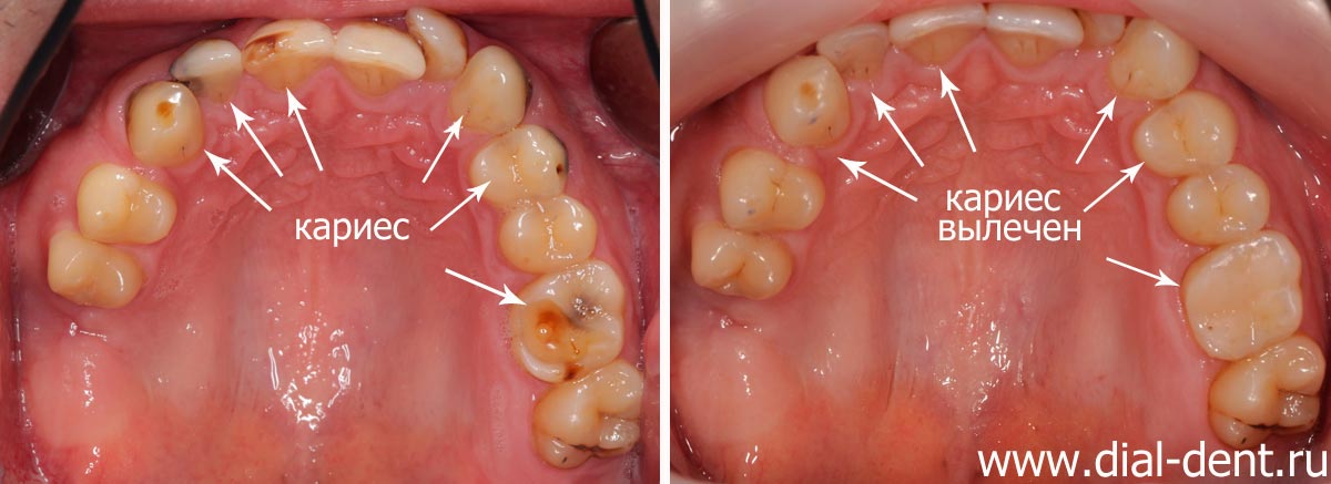 до и после лечения кариеса зубов верхней челюсти