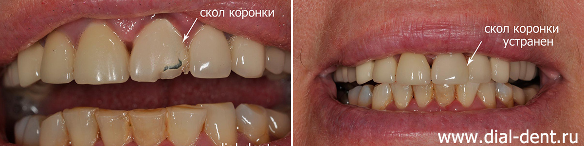 скол переднего зуба и результат реставрации скола
