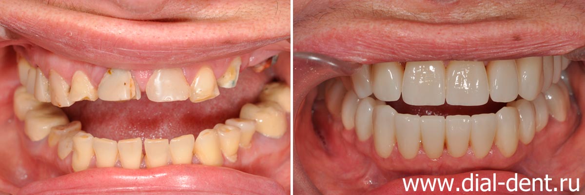 вид зубов до и после протезирования керамическими коронками