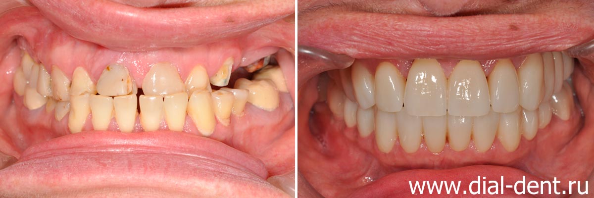 вид зубов до и после протезирования керамическими коронками
