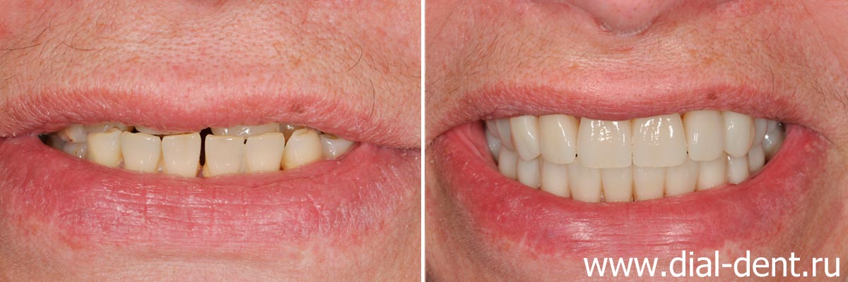 улыбка до и после протезирования зубов керамическими коронками на каркасе из оксида циркония