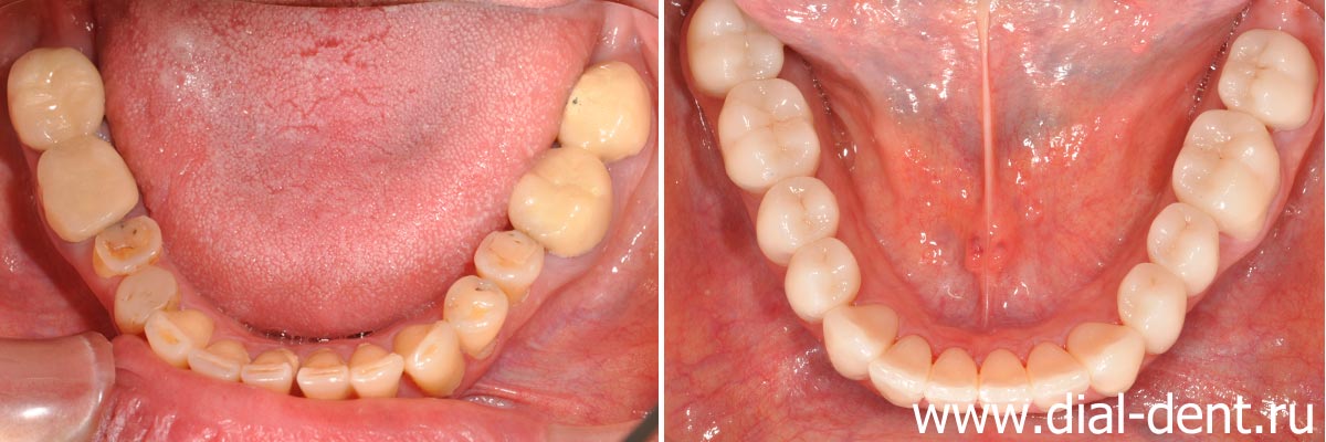 нижние зубы до и после протезирования 