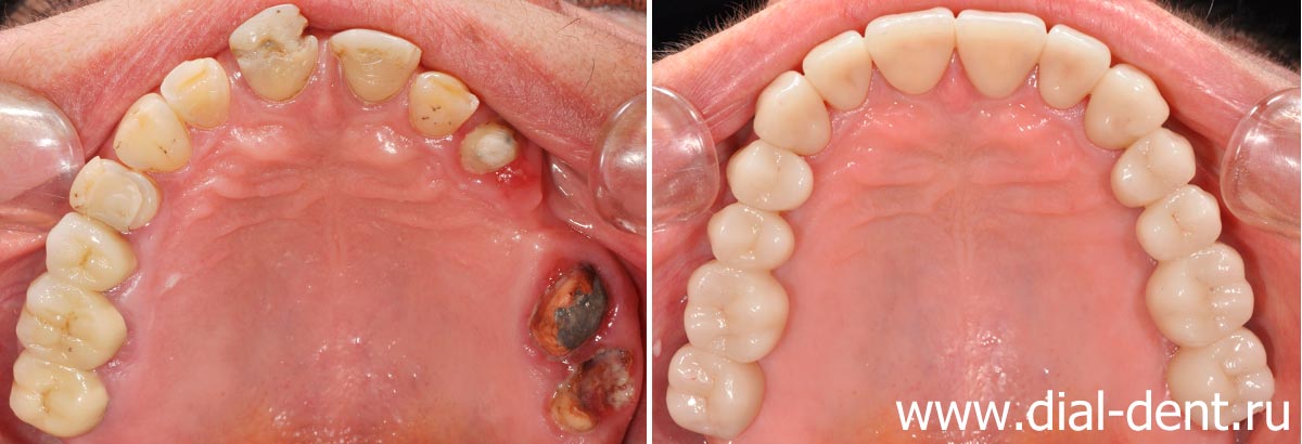 верхние зубы до и после протезирования 