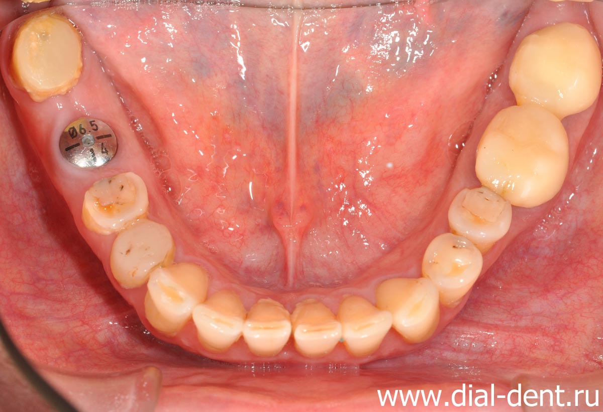 установлены зубные импланты Astra Tech на нижней челюсти