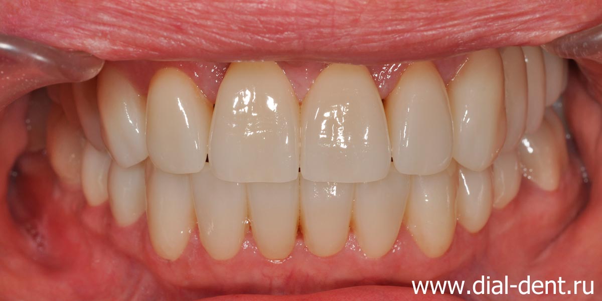 результат лечения и протезирования зубов в Диал-Дент