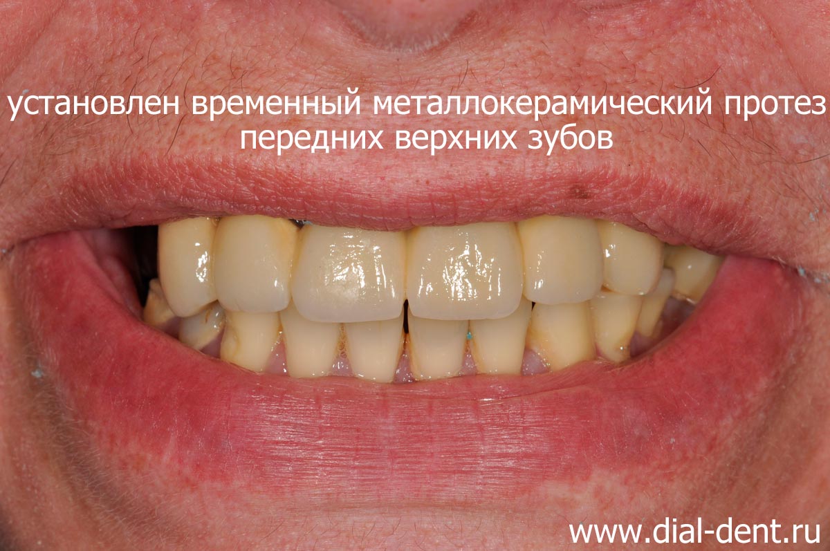 временный протез передних верхних зубов позволяет свободно общаться