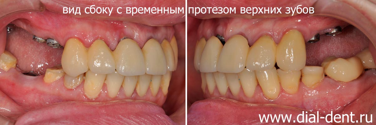 временный протез верхних зубов - вид сбоку