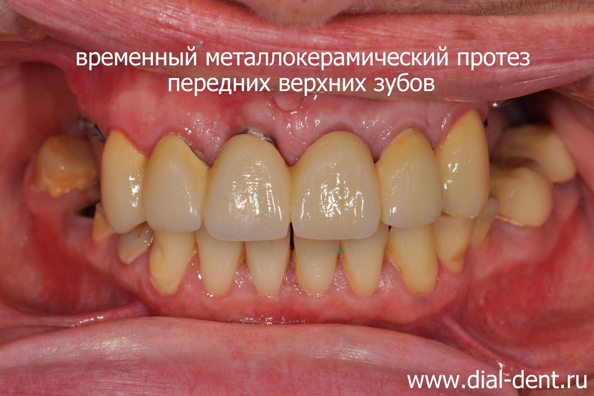 временный протез верхних зубов
