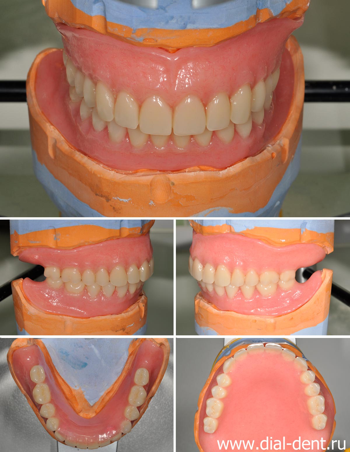 полные съемные зубные протезы в процессе изготовления
