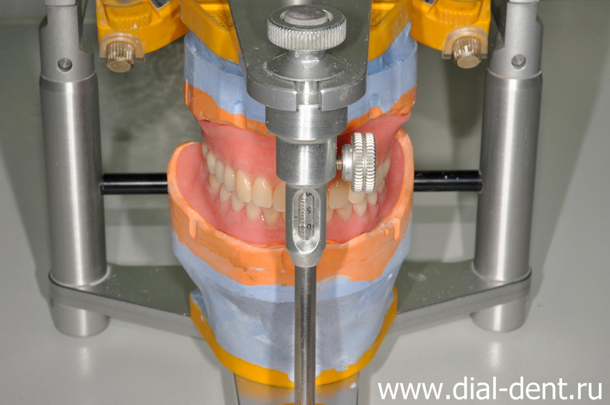 изготовление съемных протезов в зуботехнической лаборатории Диал-Дент