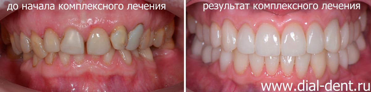вид зубов до и после комплексного стоматологического лечения