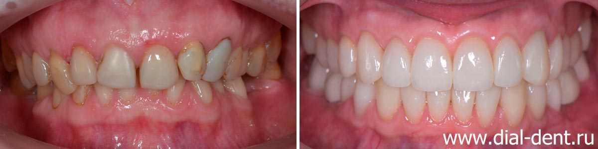 Комплексная реставрация прикуса и протезирование зубов