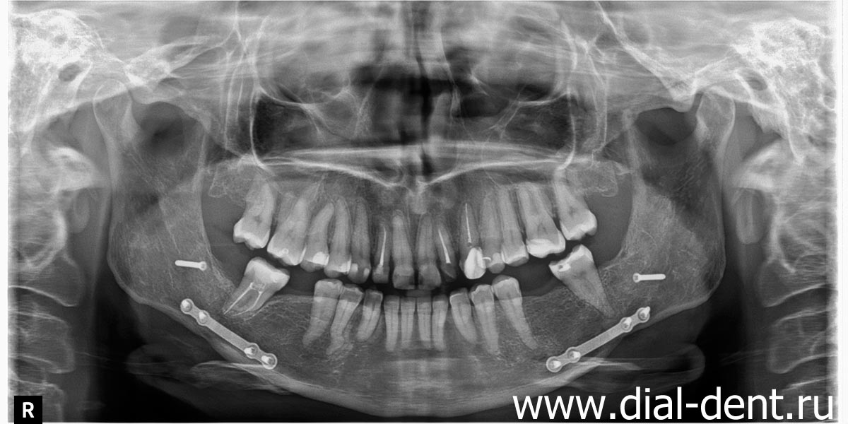 панорамный снимок зубов после исправления прикуса