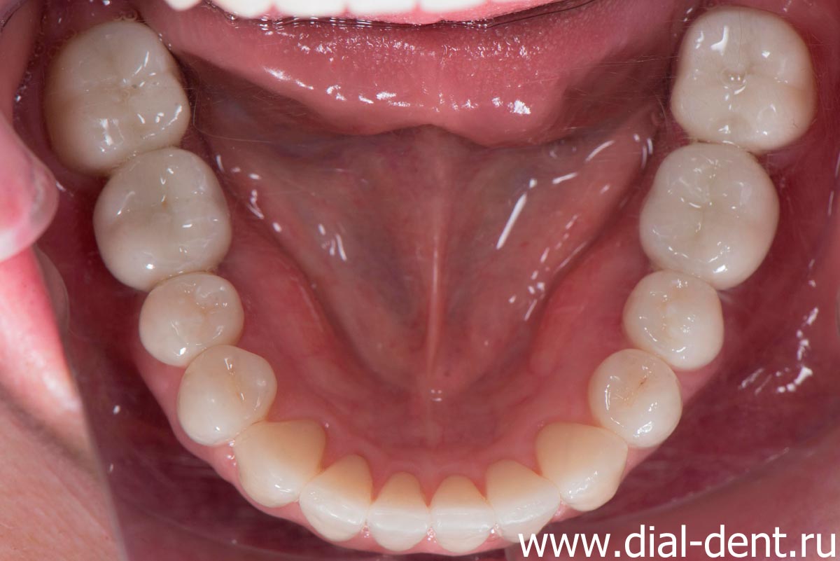 нижние зубы после протезирования