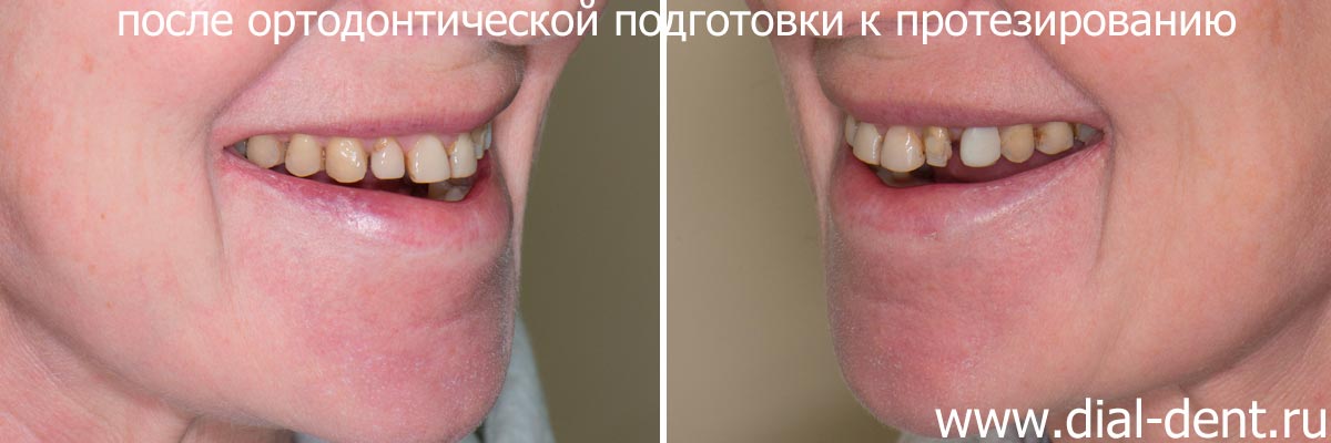 вид зубов после исправления прикуса и ортодонтической подготовки к протезированию